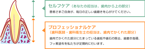 セルフケア（あなたの担当は、歯肉から上の部分）：／プロフェッショナルケア（歯科医師・歯科衛生士の担当は、歯肉でかくれた部分）