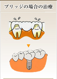 ブリッジの場合の治療