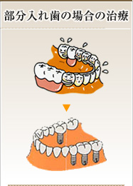 部分入れ歯の場合の治療