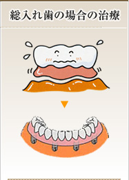 総入れ歯の場合の治療